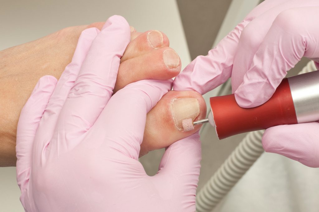 ingrown toenails